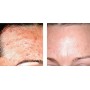 MASCARILLA DE ORO GOLD MASCK PARA ACNTE Y PUNTOS NEGROS